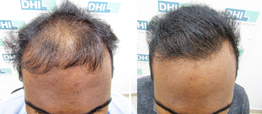 DHI before & after hair transplant results